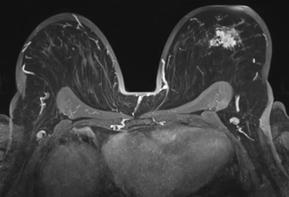 Breast MRI with a tumoral lession in the left breast, axial view. 