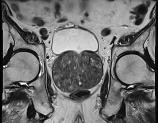 Benign Prostatic Hyperplasia (BPH) or prostate adenoma seen on MRI examination