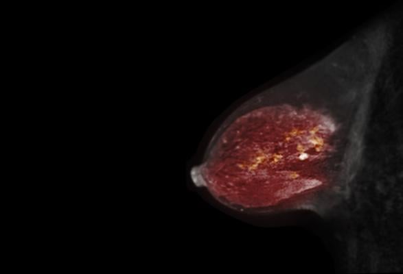 A new paper in the Journal of the National Cancer Institute, published by Oxford University Press, indicates that magnetic resonance imaging (MRI) is cost-effective for detecting breast cancer for women with very dense breasts detected by mammography.
