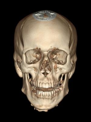 BUSM researchers have proposed a method of assigned sex estimation that is “population-inclusive” by using 3D volume-rendered computed tomography scans of ancestry skulls to estimate assigned sex at birth