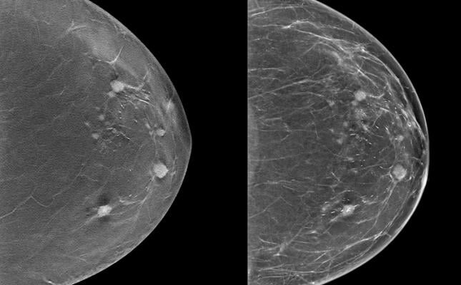 The Radiological Society of North America (RSNA) has announced the launch of the RSNA Screening Mammography Breast Cancer Detection AI Challenge. 