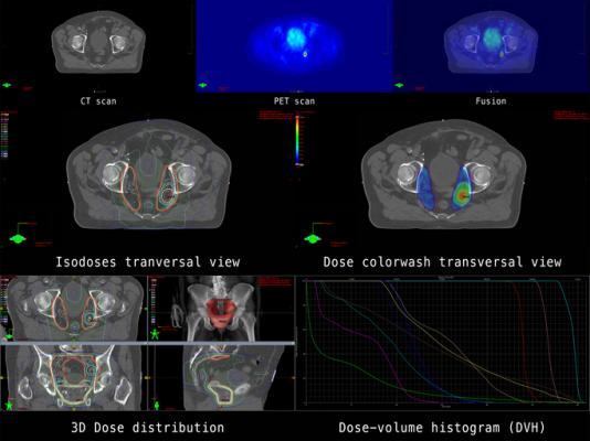 A technique that uses imaging technology as a guide can make radiation therapy safer for patients with prostate cancer by helping clinicians accurately aim radiation beams at the prostate while avoiding nearby tissue in the bladder, urethra, and rectum. 
