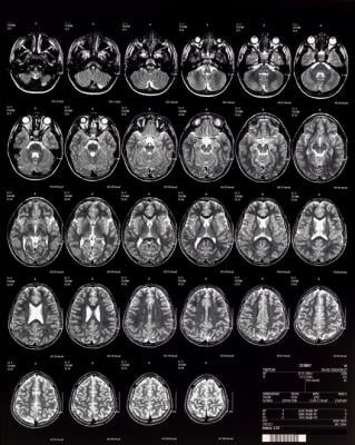 pediatric MRI brain imaging in children