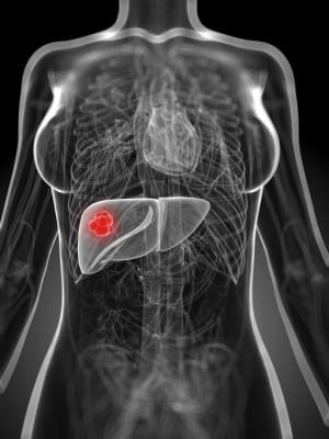 People with liver cancer awaiting transplantation could benefit from non-invasive radiation treatments but are rarely given this therapy, according to a new analysis of U.S. national data