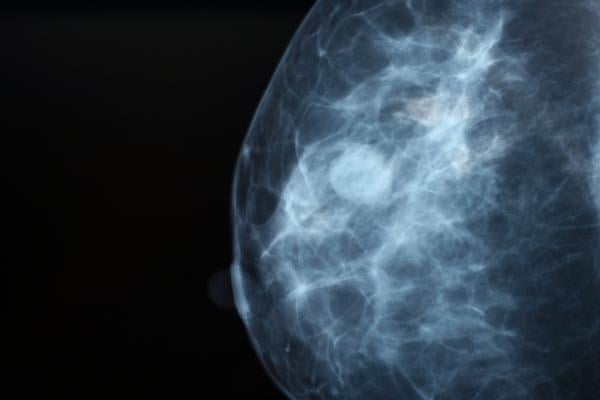 Randomized trial finds hypofractionated whole-breast radiation with concurrent boost comparable to six weeks of treatment for patients with higher-risk disease