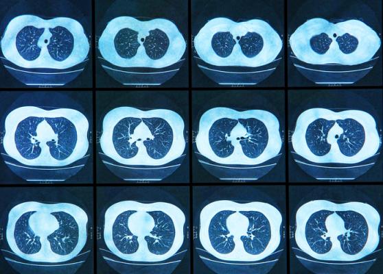 The American College of Radiology (ACR) is calling on radiologists nationally to respond to a solicitation for public comment from the Centers for Medicare and Medicaid Services (CMS) about lung cancer screening with low dose computed tomography (LDCT).