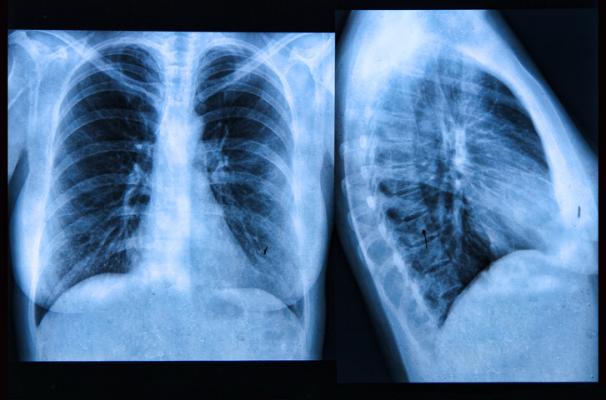 Revised guidelines for lung cancer screening eligibility are perpetuating disparities for racial/ethnic minorities, according to a new study in Radiology.
