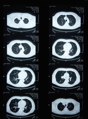 Artificial intelligence can categorize cancer risk of lung nodules