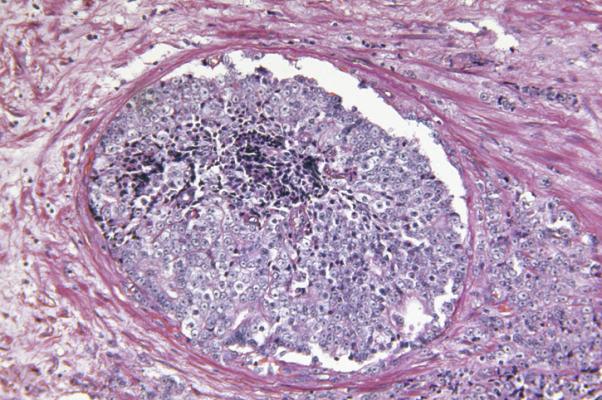 Scientists have identified two subtypes of metastatic prostate cancer that respond differently to treatment, information that could one day guide physicians in treating patients with the therapies best suited to their disease.