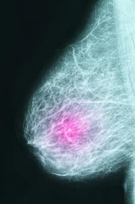 “The Fundamental Flaws of the Canadian National Breast Screening Study (CNBSS) Trials: A Scientific Review,” authored by Seely, et al and published on March 29, 2022 in the Journal of Breast Imaging, reinforces criticism directed towards the CNBSS trials.