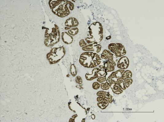 Microscopic photo of a professionally prepared slide demonstrating breast tissue with ductal carcinoma in situ (DCIS). Immuhistochemistry of estrogen receptor positive. Micrograph of breast cancer. Slide shows corresponding length of 1 mm.