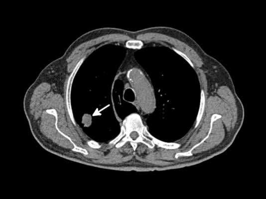 Low-dose #CT #lung #scans are used to #screen for #lung_cancer in high-risk people such as heavy #smokers