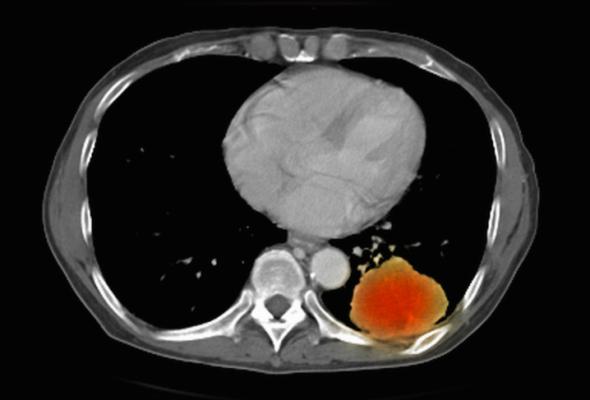 Image from a co-registered PET-CT study from dual modality scanner. Patient with multiple metastatic lesions in liver & lung. PET data superimposed over CT scan axial slice through lung metastases