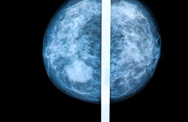 Breast density notifications aim to educate women about the risks of high breast density, defined as having more fibroglandular tissue than fatty tissue, as visualized on a mammogram.