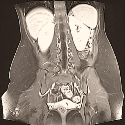 The American College of Radiology (ACR) Computed Tomography (CT) and Magnetic Resonance Imaging (MRI) Accreditation Committees have announced that a radiologist (MD/DO) will now provide direct or general supervision of intravenous contrast material administration 