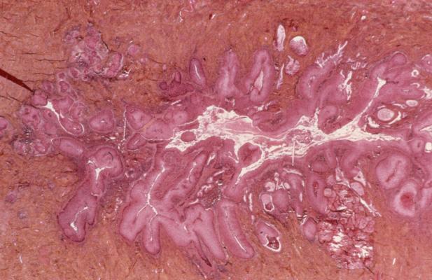 Non-invasive tests may help identify patients facing higher risk for cervical cancer recurrence, enabling early intervention