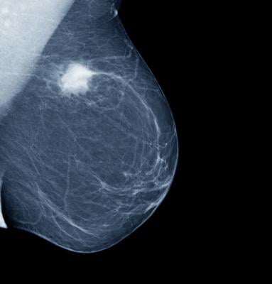 Breast cancer screening has been shown to reduce cancer fatalities. AI tools have the potential to make screening more efficient and effective. 