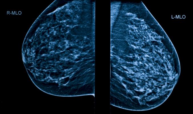 The researchers say there is currently a lack of good quality evidence to support a policy of replacing human radiologists with artificial intelligence (AI) technology when screening for breast cancer.