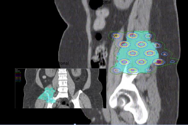 UT Southwestern, heavy ion radiation therapy, national center, first in U.S.