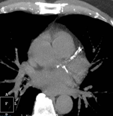 BlueCross BlueShield Companies in Eight States Issue Positive Medical Policies for HeartFlow FFRct Analysis