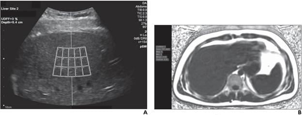 Left: UDFF—operator places crossbar at liver capsule, with sample ROI fixed 1.5 cm deep from crossbar, to ensure measurement obtained sufficiently deep to liver capsule. Overall UDFF was 3%. Right: Median MRI PDFF from three acquisitions was 3%, demonstrating agreement.