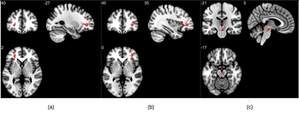 Figure 1. Group analysis on susceptibility-weighted imaging exhibiting higher susceptibility-weighted imaging values in the COVID group when compared to healthy controls. Three significant clusters were found primarily in the white matter regions of the pre-frontal cortex and in the brainstem. The clusters (a) and (b) are observed bilaterally in the cerebral white matter near the orbitofrontal gyrus, whereas (c) lies in the midbrain region.