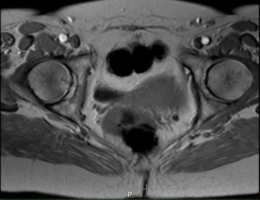 MRI Metal Artifact Reduction Poses Minimal Thermal Risk to Hip Arthroplasty Implants
