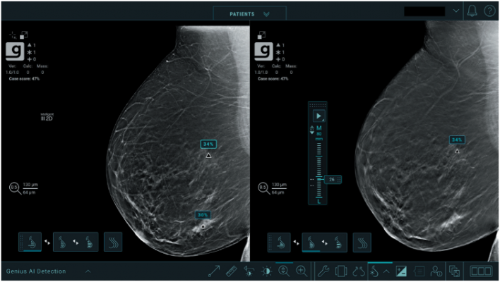 Studies show new deep-learning algorithm helps radiologists detect breast cancers in their early stages when used with the Genius 3D Mammography exam