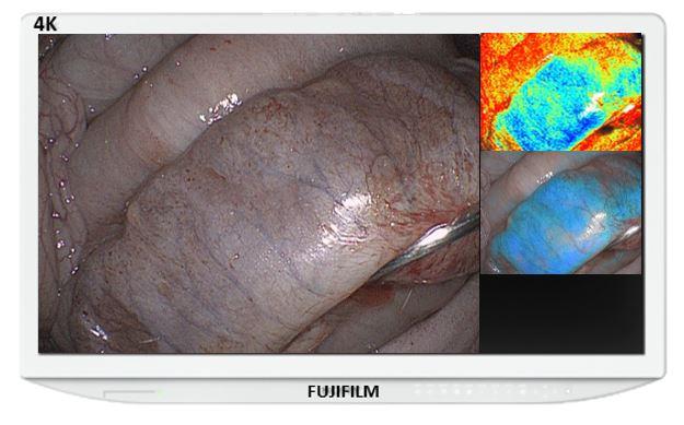 Fujifilm Medical Systems U.S.A., Inc. announced that the U.S. Food and Drug Administration (FDA) has granted 510(k) clearance for Fujifilm’s new image enhancement technology - the Oxygen Saturation Endoscopic Imaging System - which was developed to improve visualization during gastrointestinal, colorectal, and advanced endoscopy and surgical procedures. 