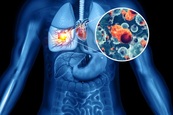 The American Cancer Society (ACS) has issued update lung cancer screening guidelines to help reduce the number of people dying from the disease due to smoking history.