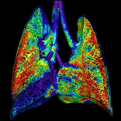 4DMedical, a global technology company and producer of advanced lung function imaging software, has received U.S Food and Drug Administration (FDA) clearance for its CT-based ventilation product (CT LVAS).