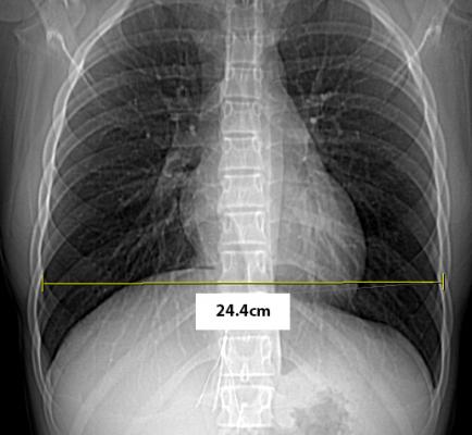 New Image Wisely Radiation Safety Case Available: Optimizing Radiation Use During a Difficult IVC Filter Retrieval