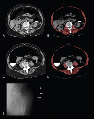 Sarcopenia (Myosteatosis) at Screening CT Colonoscopy in 79-Year-Old Woman With Subsequent Hip Fracture