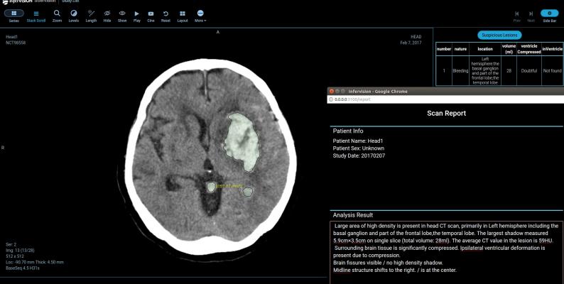 Infervision Releases InferTEST Program at SIIM 2019