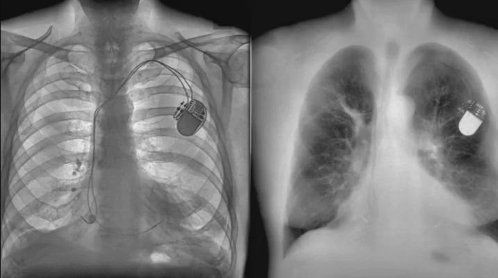 The KA X-ray technology gives doctors a clearer view of a patient's lungs by separating the bone structure (left) and soft tissue (right).