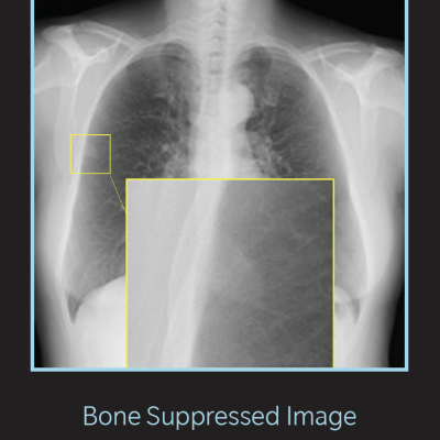 Zwanger-Pesiri Radiology Implements Bone Suppression Imaging Technology to Enhance Chest X-rays