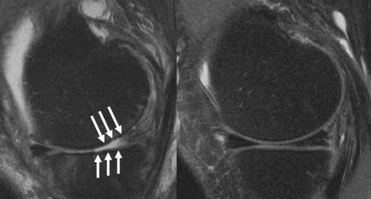 Figure 1. Knee joint of a patient showing (A) severe cartilage defects and (B) intact knee joint.