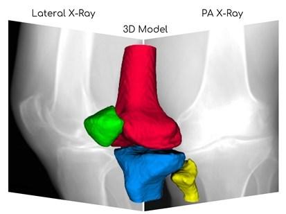 RSIP Vision, a global leader in artificial intelligence (AI) and computer vision technology, announced a new innovative AI-based solution for 3-D reconstruction of knees from X-ray images