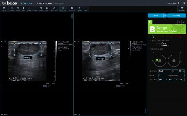 FDA Clears Koios DS Breast 2.0 AI-based Software