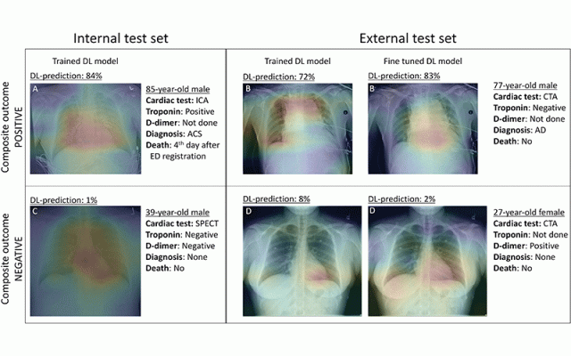 Gradient-weighted class activation maps of representative chest radiographs in (A) an 85-year-old man with acute coronary syndrome (ACS), (B) a 77-year-old man with aortic dissection (AD), (C) a 39-year-old healthy man, and (D) a 27-year-old healthy woman. The maps show which parts of the images influenced deep learning (DL) model predictions for the composite outcome. The color gradient shows the level of activation from that given area, where red indicates the highest activation, blue indicates the lowest