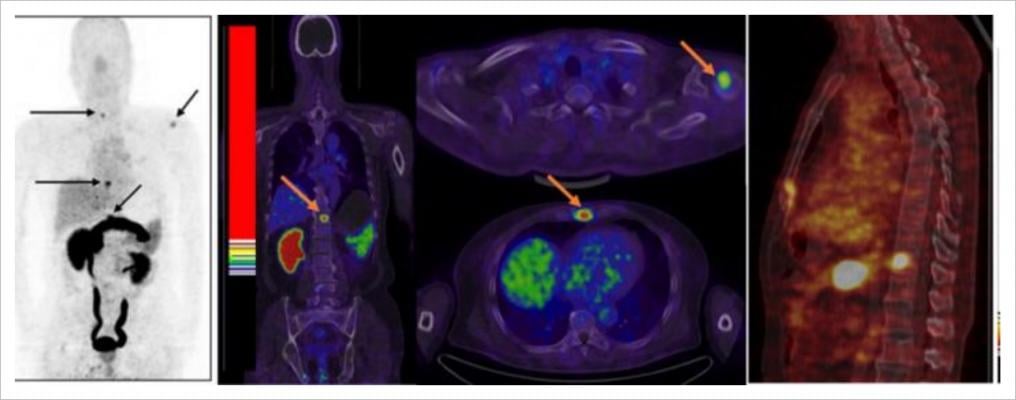 PET/CT Changes Care for 59 Percent of Suspected Recurrent Prostate Cancer Cases