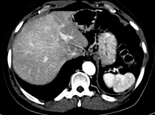 UCLA Study Offers Roadmap to Personalized Therapies for Sarcoma