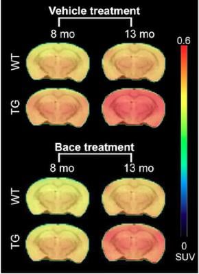 PET Tracer Gauges Effectiveness of Promising Alzheimer's Treatment