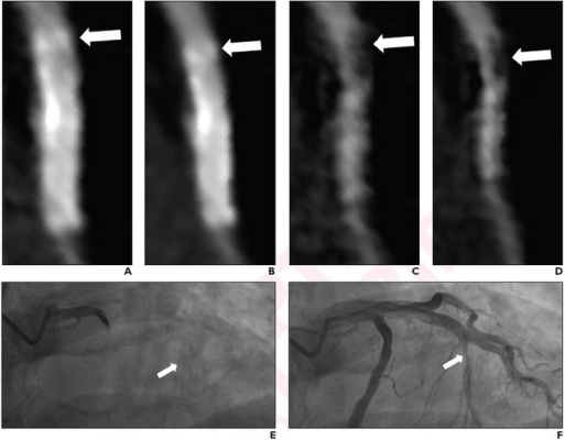 57-year-old man who underwent coronary CTA using two-breath-hold subtraction technique to assess patency of coronary artery stent.  
