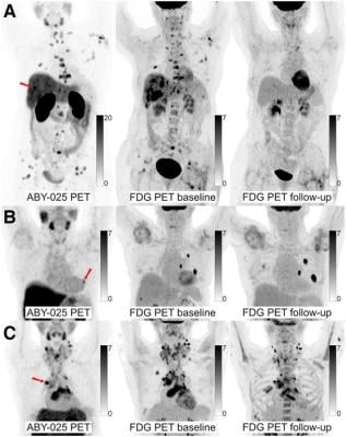 68Ga-ABY-025 PET/CT and 18F-FDG PET/CT images at baseline with 18F-FDG PET/CT follow-up after 2 cycles of treatment in biopsy-confirmed HER2-positive disease
