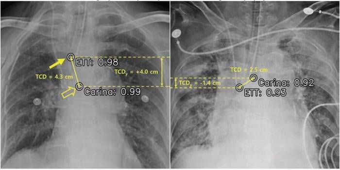 AI system by Lunit identified improperly positioned endotracheal tube on chest radiographs obtained after insertion, as well as on chest radiographs obtained from patients in the ICU at two institutions 