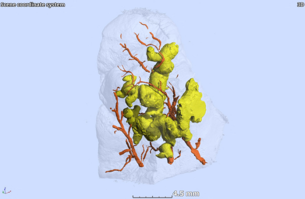 Three-dimensional segmentation of ginger-root shaped necrotic lesions (yellow) and surrounding vasculature (red) within a sample of Mycobacterium tuberculosis-infected human lung tissue (transparent surface). Africa Health Research Institute 