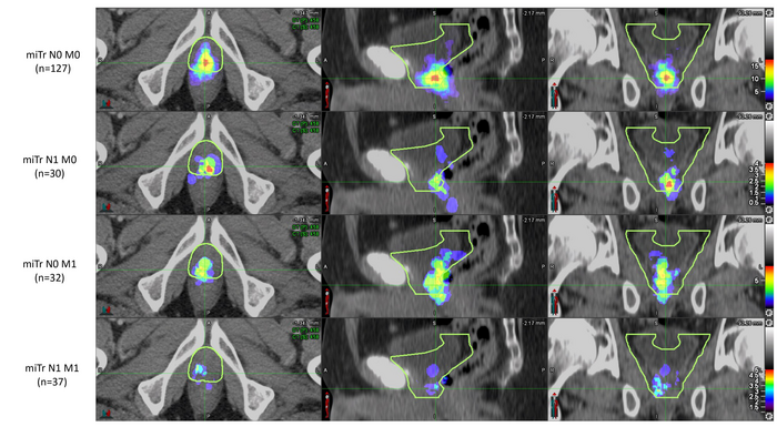 Heat maps of PSMA PET prostatic fossa recurrence in patients with recurrence limited to the prostate fossa (miTr N0 M0, n=127), pelvic nodal disease (miTr N1 M0, n=30), distant organs/extra-pelvic nodal disease (miTr N0 M1, n=32) and pelvic nodal plus distant organs/extra-pelvic nodal disease (miTr N1 M1, n=37). The yellow contour represents the RTOG CTV