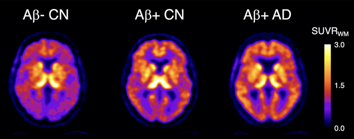 18F-SMBT-1 PET studies showed that beta-amyloid+ Alzheimer’s disease (AD) patients, but most importantly, beta-amyloid+ controls (CN) have significantly higher regional 18F-SMBT-1 binding than beta-amyloid- CN, with 18F-SMBT-1 retention highly associated with beta-amyloid burden. These findings suggest that increased 18F-SMBT-1 binding is detectable at the preclinical stages of beta-amyloid accumulation. 