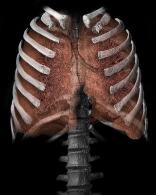  Lung 3D from CT scan_Vital Images
